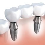 dental-implants
